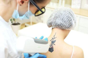 Thread Vein Removal on Face Explained