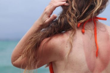Professional Skin Tag Removal: What You Should Know