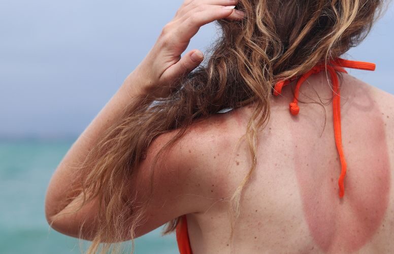 Sunburned shoulders after excessive UV exposure on a beach