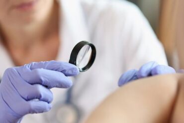Professional Skin Tag Removal: What You Should Know