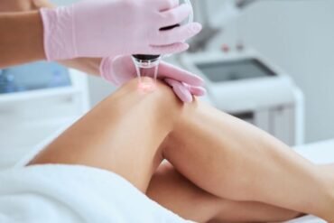 Best Treatments for Broken Capillaries